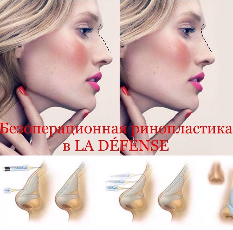 Филеры для ринопластики Филеры для ринопластики